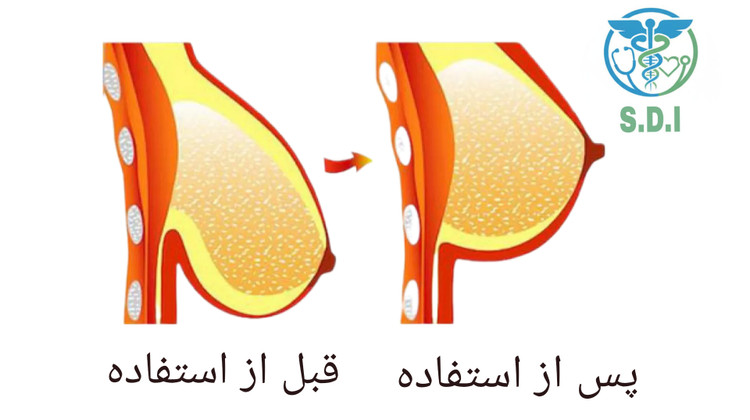 وکیوم سینه بانوان راد مد سایز مدیوم ولارج | بزرگکننده و فرمدهنده سینه